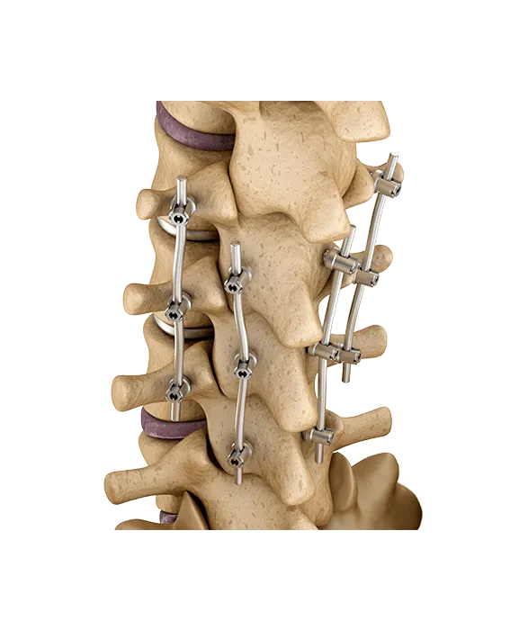 Spine Fixation
